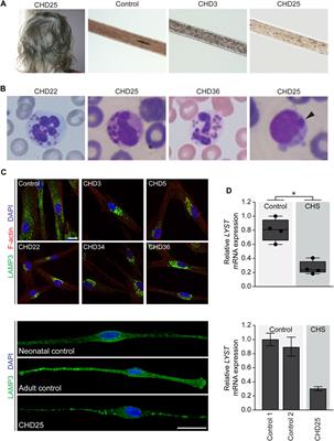 cDNA sequencing increases the molecular diagnostic yield in Chediak-Higashi syndrome